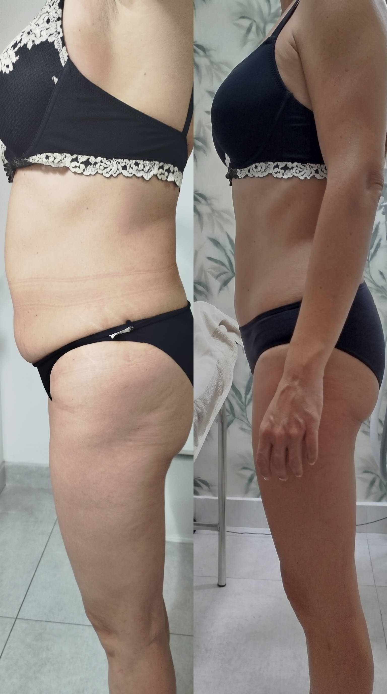 Resultado real: antes y después tratamiento corporal